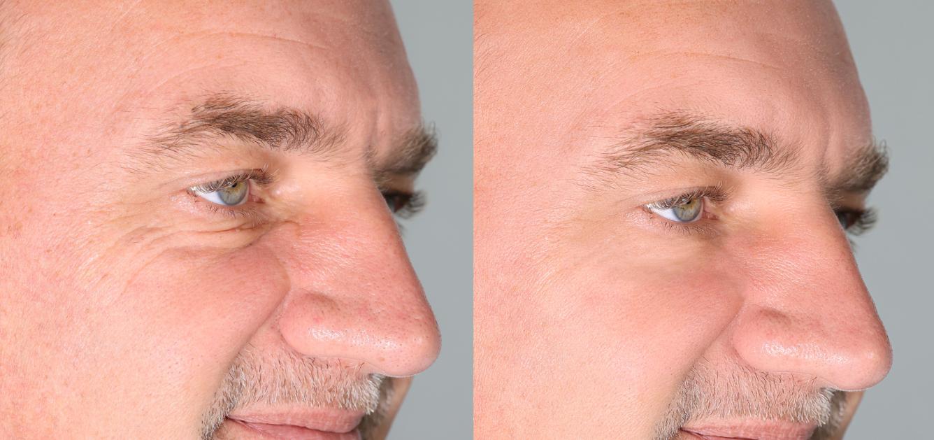 Before and after Botox treatment around the eyes.