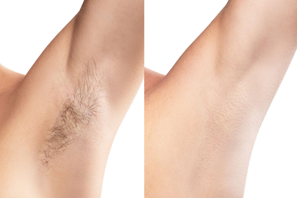 Underarm before and after laser hair removal treatment.