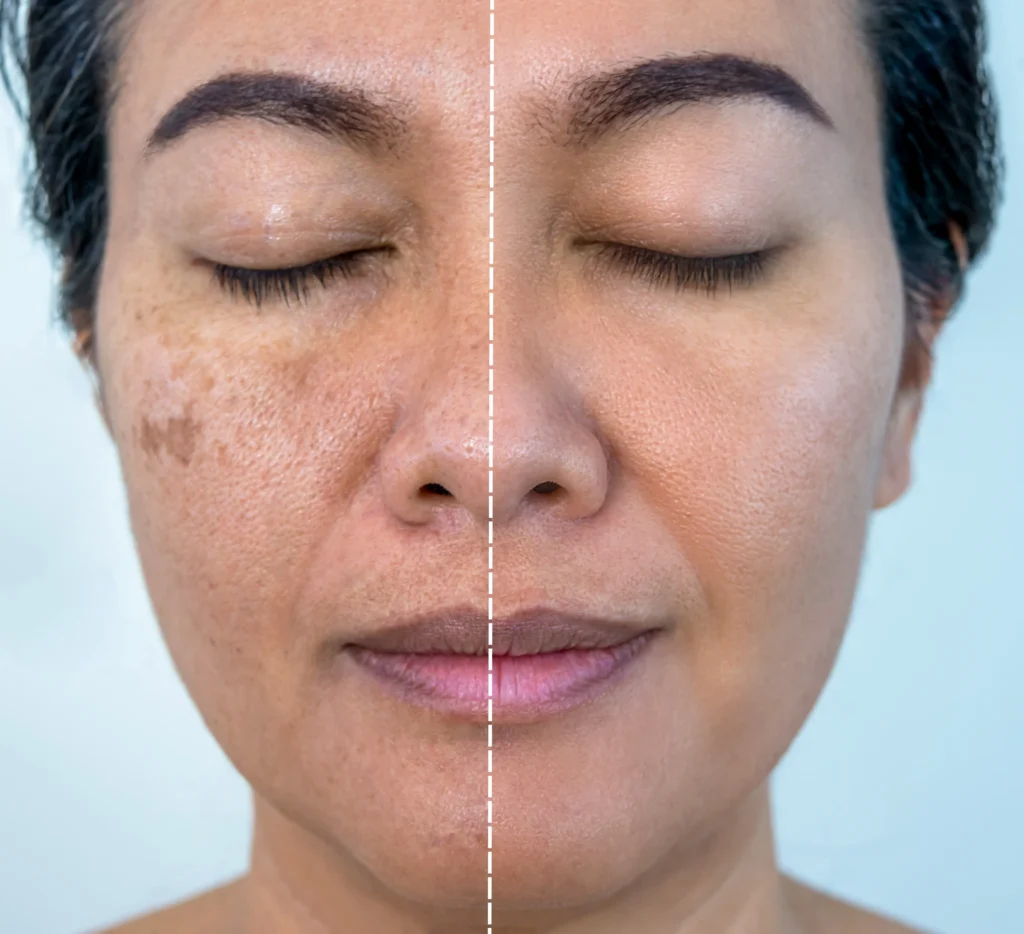Before-and-after facial comparison showing differences in visible dark spots and skin tone
